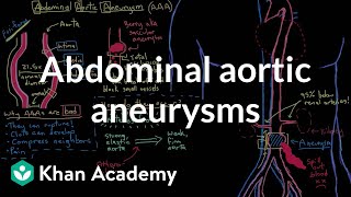 Abdominal aortic aneurysms  Circulatory System and Disease  NCLEXRN  Khan Academy [upl. by Troxell]