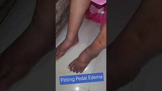 Pitting Pedam Edema Pedal Edema Pittingedema legswelling [upl. by Haliehs]