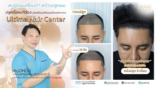 รีวิวปลูกผม ผู้ชาย 9 เดือน  Ultima Hair Center ปลูกผมหมอหมิง Line Ultima [upl. by Uphemia576]