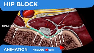 Hip Block  NYSORAs Reverse Ultrasound™ Animation [upl. by Rehsu639]