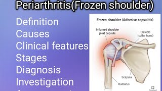 PeriarthritisFrozen shoulderEasy Notes PT Arthopedic condition  Assessment amp PT Management [upl. by Wettam]