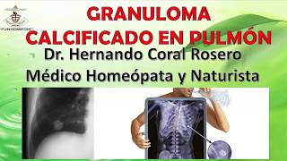 GRANULOMA CALCIFICADO EN PULMÓN TUMORACIÓN EN EL PULMÓN [upl. by Stillas]