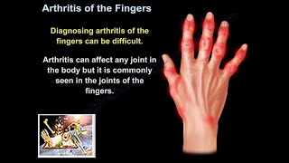 Arthritis Of The Fingers  Everything You Need To Know  Dr Nabil Ebraheim [upl. by Chloras]