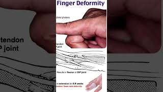 mallet finger deformitythephysiodoctoranatomyphysiotharapisthumananatomymotivationbiology [upl. by Nanor121]