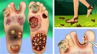 ASMRathletes foot hand finger maggot between toes picturesinfection removal ANIMATIONS [upl. by Anwahsak]