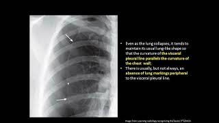 Lecture 7  Pneumothorax pneumomediastinum pneumopericardium and subcutanous emphesyma [upl. by Chan]