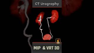 CT Urography  MIP amp VRT 3D  Rad Shorts [upl. by Ilarrold]