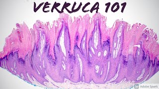 Wart under microscopeVerruca 101 More than you ever wanted to know Pathology Dermatology Dermpath [upl. by Janetta]