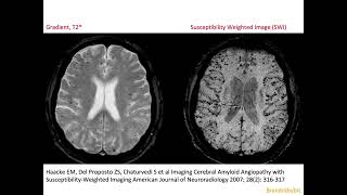 68 CAA Cerebral Amyloid micro Angiopathy vascular dementia micro bleeds superficial siderosis [upl. by Philipp]