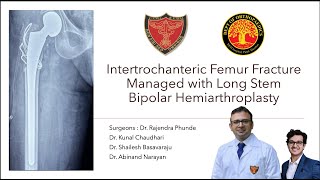 Long Stem Bipolar Hemiarthroplasty for Intertrochanteric Femur Fracture StepbyStep Surgical Guide [upl. by Eednak]