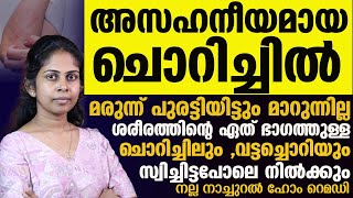 വട്ടച്ചൊറിയും ചൊറിച്ചിലും മാറ്റാൻ നല്ല നാച്ചുറൽ ഹോം റെമഡി ഇതാChorichil Maattaan [upl. by Senn306]