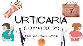 Urticaria  Dermatology Pathophysiologyclinical featuresdiagnosistreatment MedVidsMadeSimple [upl. by Noimad]