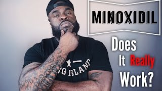 Does Minoxidil Really Work  Minoxidil Beard Growth [upl. by Filberto]