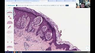 Avi Bitterman Dermpath Lecture 4 Melanocytic [upl. by Otrebcire]