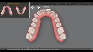 Dr Nimrod Dykstein Case 1 class 2 div2 with deep overbite [upl. by Dhiman]