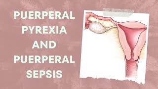 Understanding Puerperal Pyrexia and Puerperal Sepsis Causes Symptoms and Treatment [upl. by Ima]