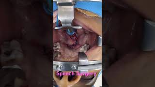 Speech Surgery to correct nasality in voice and depth by dr richardson [upl. by Larsen]