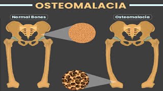 OSTEOMALACIA [upl. by Isle]