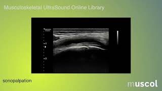 Knee medial plica syndrome [upl. by Kilk]