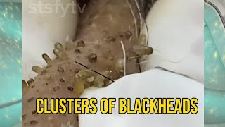 Clusters of Old Age Blackheads  Satisfying  ASMR blackheads blackheadremoval satisfying [upl. by Lumbard]