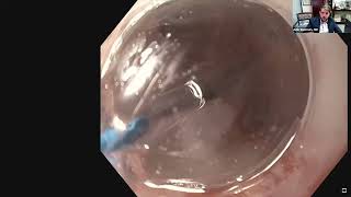 trūFreeze CryoDilation Talk – Dr Amir Rumman [upl. by Neirrad730]