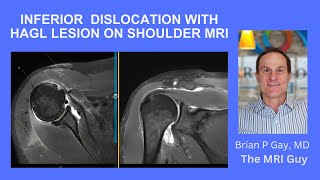 Inferior shoulder dislocation with HAGL lesion on MRI [upl. by Philps616]