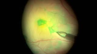 Myopic macular hole with RD  PPV  inverted ILM flap [upl. by Marshal]