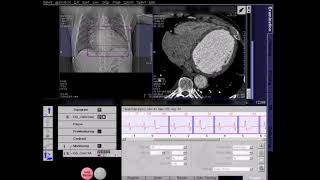 ECG Editing For CT Coronary Angiography  Heart Rate Atrial Fibrillation [upl. by Aay913]