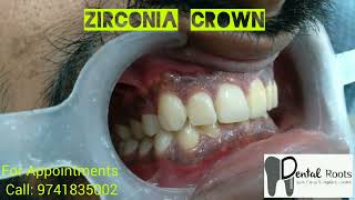 zirconia crown metal free crowns  smile designing [upl. by Ideih480]