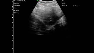 SonoStar wireless ultrasound view of the IUD in utero ultrasoundtech ultrasonic [upl. by Jollanta]