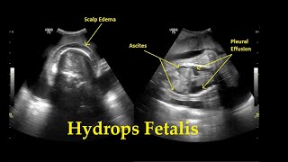 Hydrops Fetalis  Ultrasound  Anomaly  Case 26 [upl. by Entsirhc]