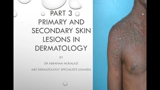 PRIMARY AND SECONDARY SKIN LESIONS CONFIGURATION AND DISTRIBUTION OF SKIN DISEASESeducation duet [upl. by Rouvin]