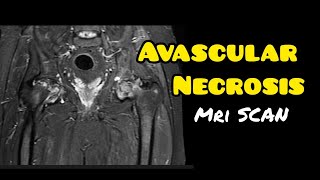 Avascular necrosis  Osteonecrosis  MRI HIP JOINT  Radiology [upl. by Enailil]