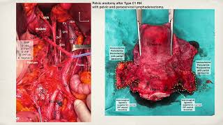 NerveSparing Radical Hysterectomy  Simplifying Type C1 RH by Dr Ilker SELCUK [upl. by Enohsal837]