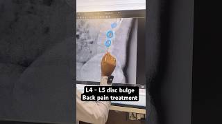 L4  L5 disc bulge chiropractic treatment trending shortfeed trend [upl. by Bernarr]