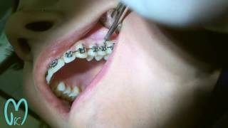 Orthodontic MiniImplants Placement  الزراعات المصغرة المساعدة لتقويم الأسنان [upl. by Anawait]