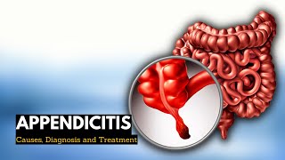 Appendicitis Causes Signs and Symptoms Diagnosis and Treatment [upl. by Enilorak]