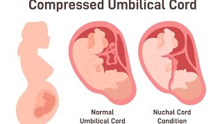 Was Your Baby’s HIE Brain Injury From A Nuchal Cord Preventable [upl. by Pelagias]