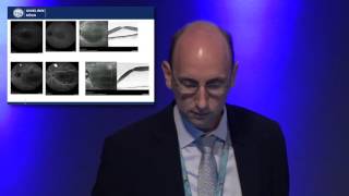 EuretinaESCRS 2016  Subthreshold Laser Therapy for Central Serous Chorioretinopathy [upl. by Hairahs]