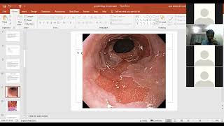 Gastrointestinal Pathology Clinical Representation  Esophagus Cancer  Stomach Disorders [upl. by Stephannie]