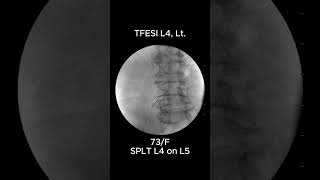 How to Accurately Perform L4 Transforaminal Epidural Steroid Injection TFESI 1 [upl. by Zacks]