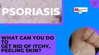 Psoriasis Treatments for You Get Rid of That Itchy Painful Rash [upl. by Ydroj]