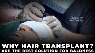 Why Hair Transplants are the Best Solution for Baldness  Trichometric Sapphire FUE  Cara Clinic [upl. by Benedicta]