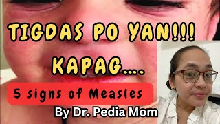 5 SIGNS may TIGDAS si baby Symptoms of Measles in Children by Dr Pedia Mom [upl. by Ahsiekim739]