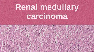 Renal Medullary Carcinoma  Pathology mini tutorial [upl. by Lairret]