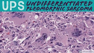 Undifferentiated Pleomorphic Sarcoma 101 UPS formerly malignant fibrous histiocytomaMFH [upl. by Ytisahc]