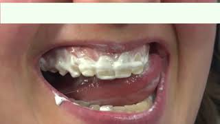 How to use GC Tooth Mousse Plus [upl. by Ennire822]