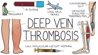 Understanding Deep Vein Thrombosis DVT [upl. by Lashar]