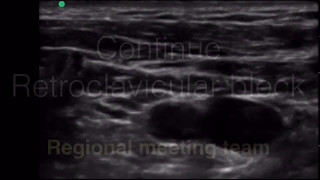 Continue Retroclavicular Brachial Plexus block [upl. by Thorndike117]