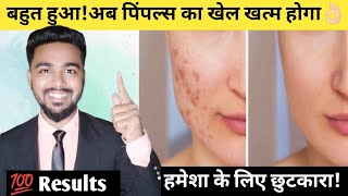 Pimple removal on face at homePimples removalPimple ke daag kaise hatayePimples hatane ka tarika [upl. by Triny657]